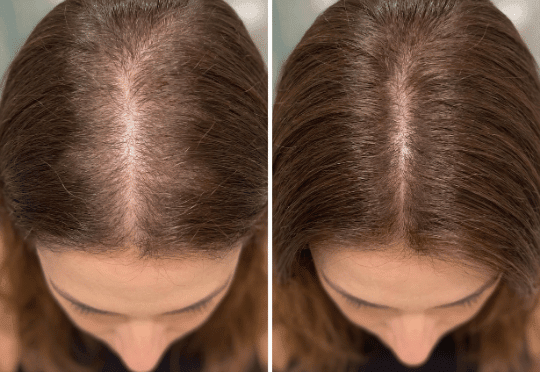 Antes e Depois Soliv - SOLIV